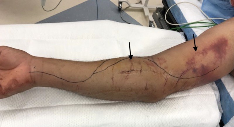 HBOT Therapy For Compartment Syndrome/ Post Fasciotomy in Aurangabad